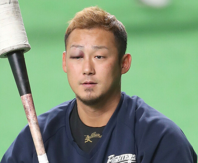中田翔の目の腫れは殴られた バットを折った日に転んで目を負傷も明らかにおかしい痣の痕の真相は もとゆン